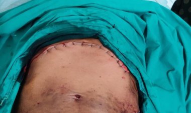 मुख्यमंत्री चिरंजीवी स्वास्थ्य बीमा योजना के तहत लिवर के ट्यूमर का हुआ ऑपरेशन